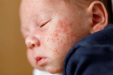 Closeup Of Baby Face Skin With Pimples And Acne From Dermatitis Stock
