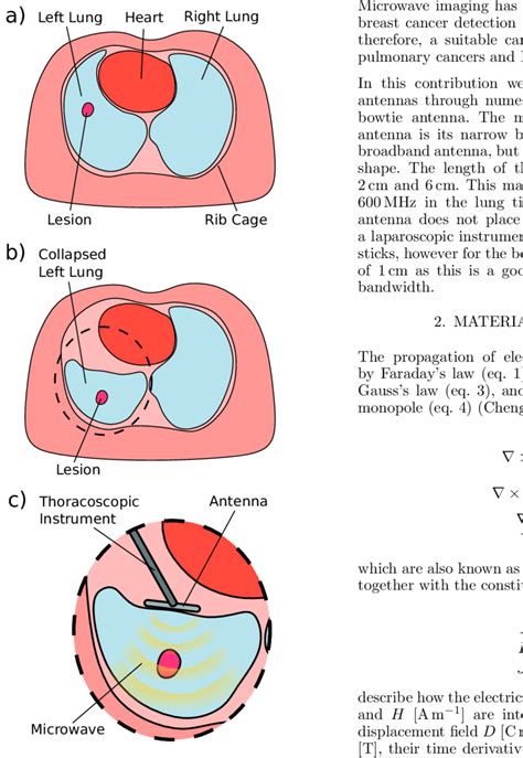 Schematic Of The Thorax Before And During Thoracoscopy A Cross