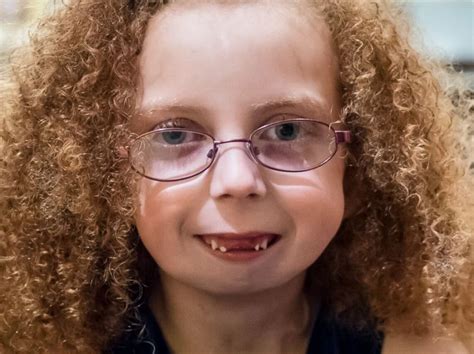 Doctors Create A New Jaw For A Girl Born Without One Inverse