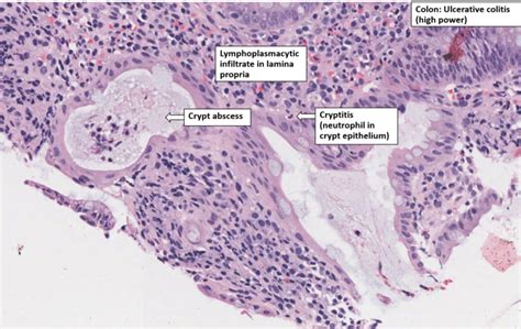 Colon Ulcerative Colitis Nus Pathweb Nus Pathweb