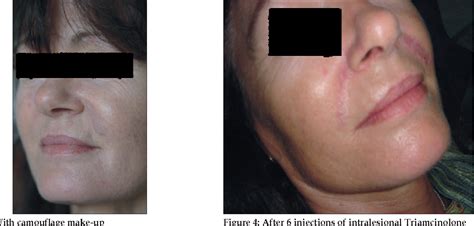 Figure 3 From Facial Granulomas Secondary To Injection Of Semi