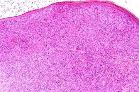 Uncommon Skin Cancer Pleomorphic Dermal Sarcoma Bmj Case Reports