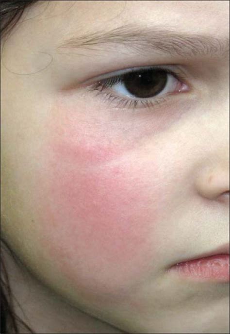 Right Facial Cellulitis Nude Pics Comments