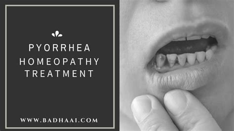 Pyorrhea Pyria Treatment And Medicines In Homeopathy