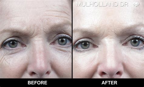 Botox Face Lifting 5 Years Younger In 30 Minutes