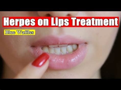 Herpes is divided into two types: How to Treat Herpes on Lips and Mouth - YouTube
