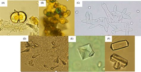 Various Shapes Of Calcium Oxalate Crystals A Dumbbell Shape X