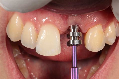 Implant insights - the implant impression - Dentistry