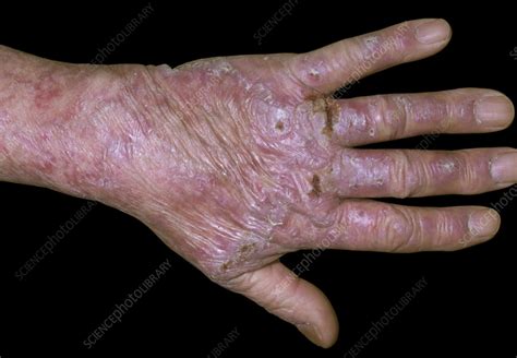 Guttate Psoriasis On A Mans Hand Stock Image C0586314 Science