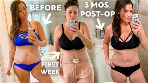 Affordable Mommy Makeover Costs Getting Your Pre Baby Body Back