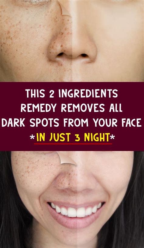 this 2 ingredient remedy removes all spots from your face in just 3 nights how to remove