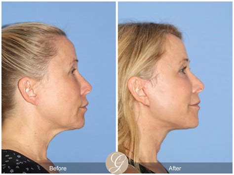 Neck Lift 488 Before After Photos Orange County