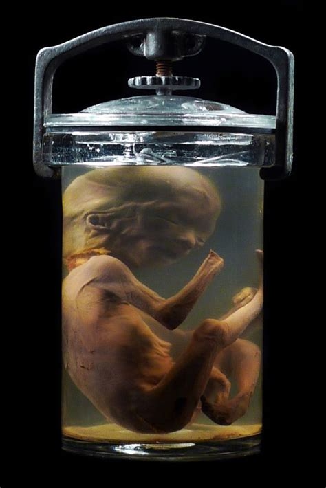 Fetus Specimen Mutter Museum Mystery Pinterest