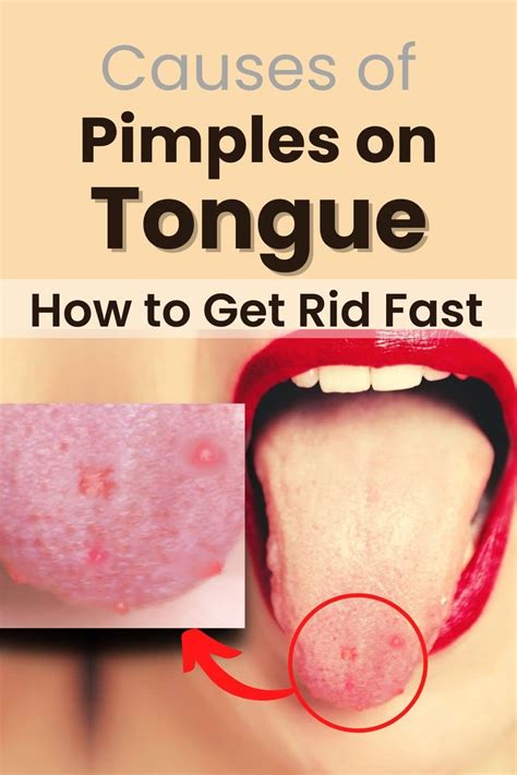 Pimples On Tongue Lie Bumps Tongue Causes Get Rid Of It Mg