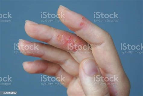 Atopic Hand Dermatitis Eczema On The Fingers Stock Photo Download