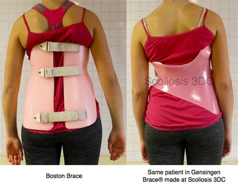 Which Scoliosis Brace Is Best Scoliosis Scoliosis Brace Scoliosis