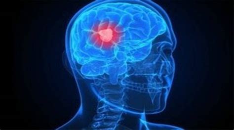 World Brain Tumour Day Know The Causes Symptoms And Treatment