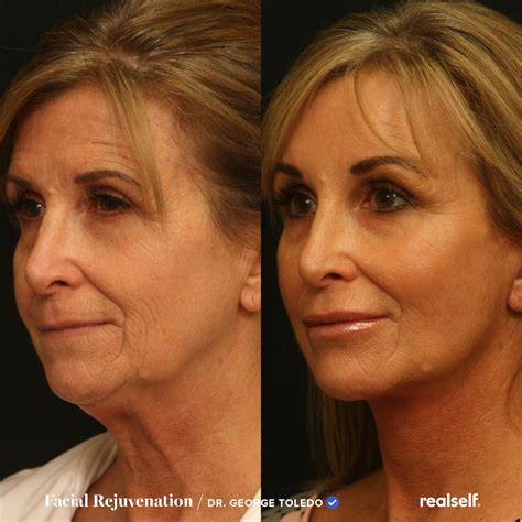How Much Does A Facelift Cost And Is It Worth It Artofit
