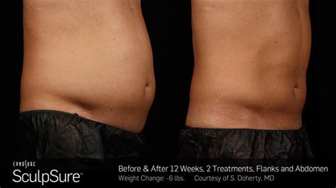 Sculpsure Before And After Gallery Dermatologist In Honolulu Hi
