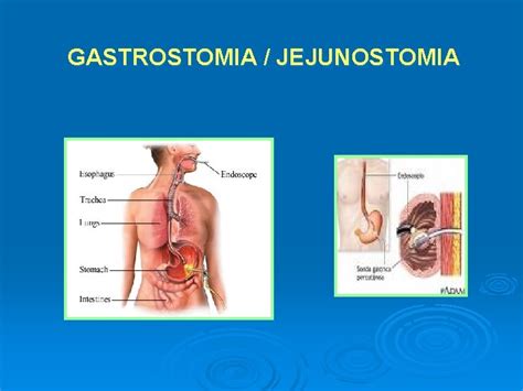 Quais Os Tipos De Estomias Voc Conhece Gastrostomia