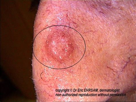 Dermoscopy Squamous Cell Carcinoma