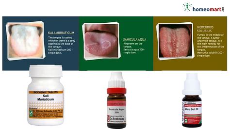 Tongue Diseases And Homeopathic Treatment Medicines List