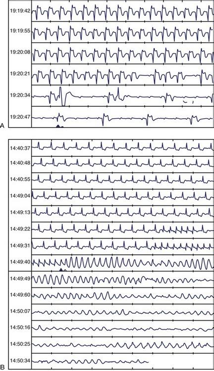 Nonsustained Ventricular Tachycardia Thoracic Key