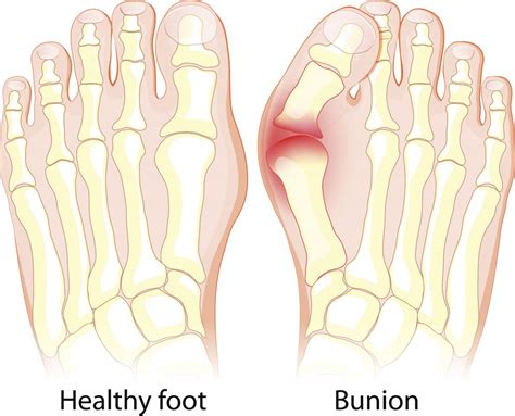 Flat Feet Symptoms Exercises Diagnosis And Treatment