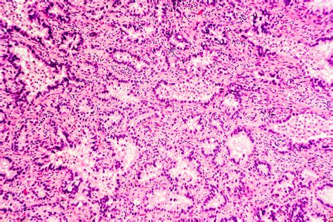 Shortness of breath with activity FDA Approves First Liquid Biopsy Test for EGFR Mutations ...