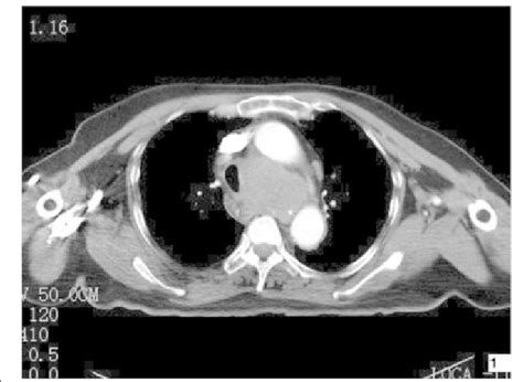 Axial Contrast Enhanced Ct Image Of The Chest Shows A Well Defined
