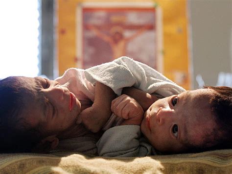 Conjoined Twins Warning Graphic Images