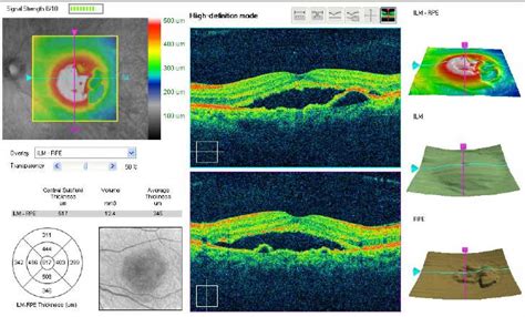 Glaucoma Boston Oct Scan Boston Neec