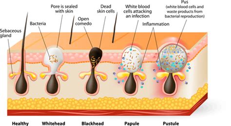 Acne 101 Melbourne Skin And Dermatology