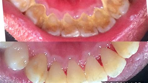 Tartar removal | Calculus removal | Dental Plaque Removal - YouTube