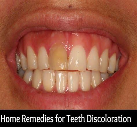 Medi Craze Home Remedies For Teeth Discoloration Home Remedies
