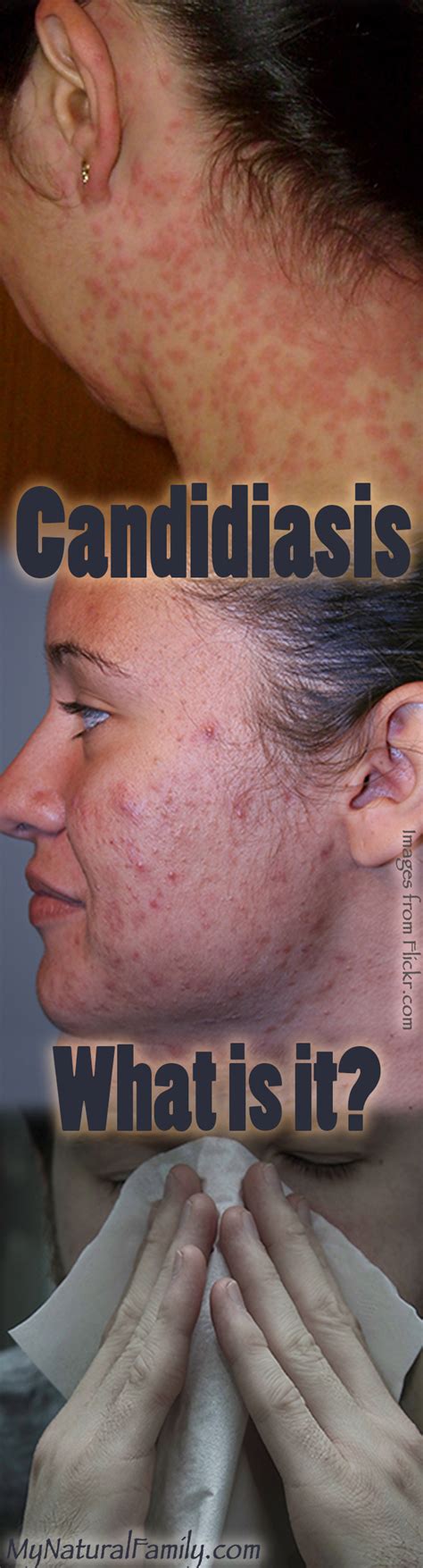 Candidiasis Skin Rash Treatment