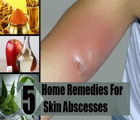How To Treat Skin Abscess