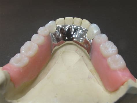 Removable Partial Dentures Uses Of Guide Planes Telegraph
