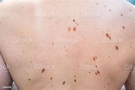 Melanocytic Nevus Some Of Them Dyplastic Or Atypical On A Caucasian Man