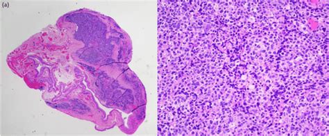 A Histopathology Slide Demonstrating Sebaceous Carcinoma On The Right