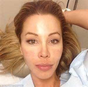 Real Housewives Of Miamis Lisa Hochstein Has Vampire Facial Daily