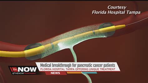 New Treatment Offers Hope For Pancreatic Cancer Patients Channels