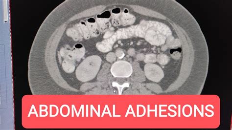 Diagnosing Abdominal Adhesions YouTube