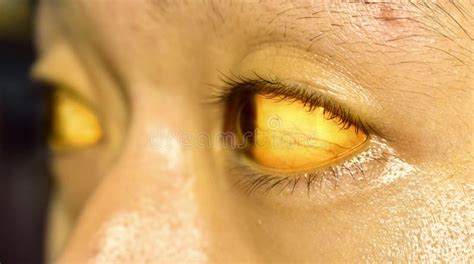 Yellowish Discoloration Of Skin And Sclera Or Deep Jaundice In Face Of