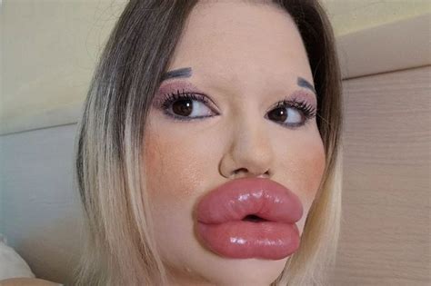 Woman With Worlds Biggest Lips Wants More Filler Despite Fans Fearing Theyll Burst