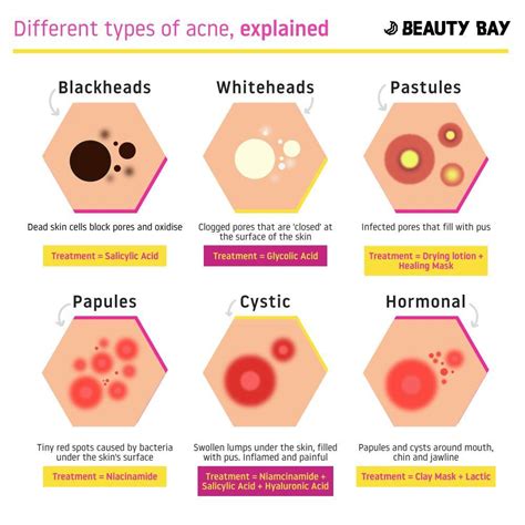 Different Types Of Acne And How To Treat Them Rcoolguides