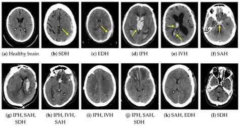 Applied Sciences Free Full Text Intracranial Hemorrhage Detection