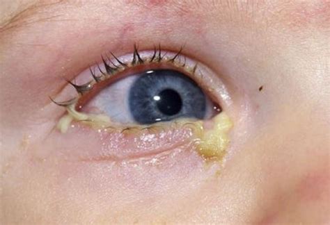 6 Things To Know About Conjunctivitis In Children Pink Eye Page 5