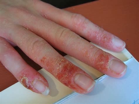 Heat Blisters On Hands