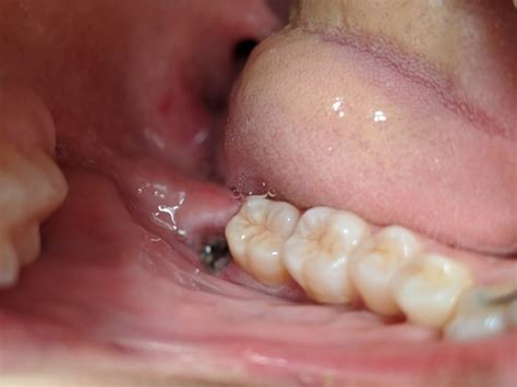 There are already a number of questions that have been asked and answered on dry socket on quora. How long will my mouth be sore after dry socket?